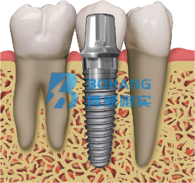 Titanium alloy dental post